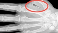 Impiego. Chip sottopelle al posto del badge. E' realtà