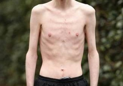foto di un ragazzo affetto da anoressia